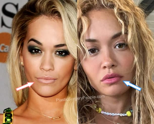 Rita Ora lip fillers before and after photo