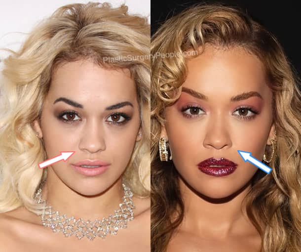 Rita Ora nose job before and after photo