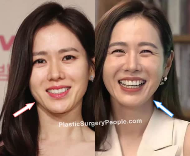 Son Ye Jin botox before and after photo