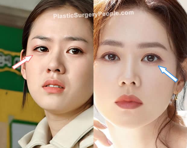 Son Ye Jin eyelid surgery before and after photo