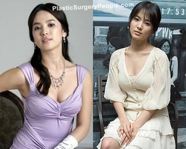 Song Hye Kyo boob job before and after photo