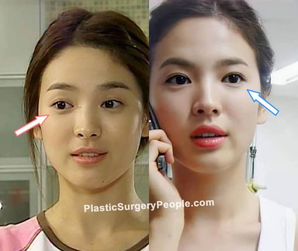 Song Hye Kyo eyelid surgery before and after photo