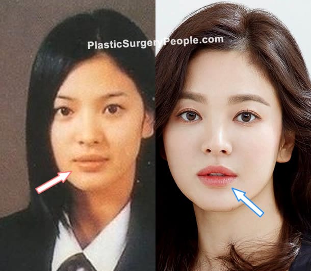 Song Hye Kyo lip fillers before and after photo